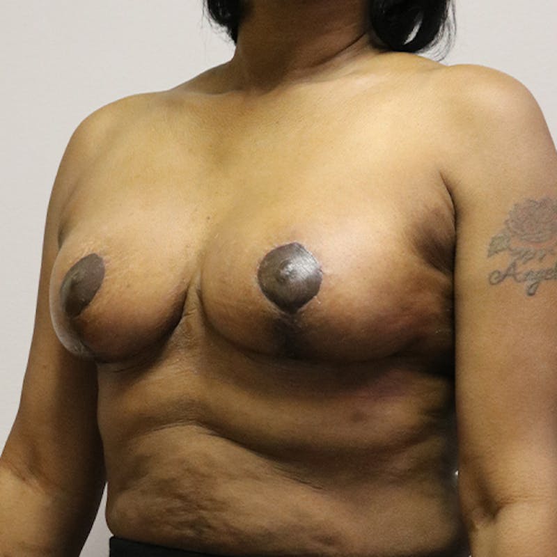 Breast Lift Before & After Gallery - Patient 843161 - Image 4