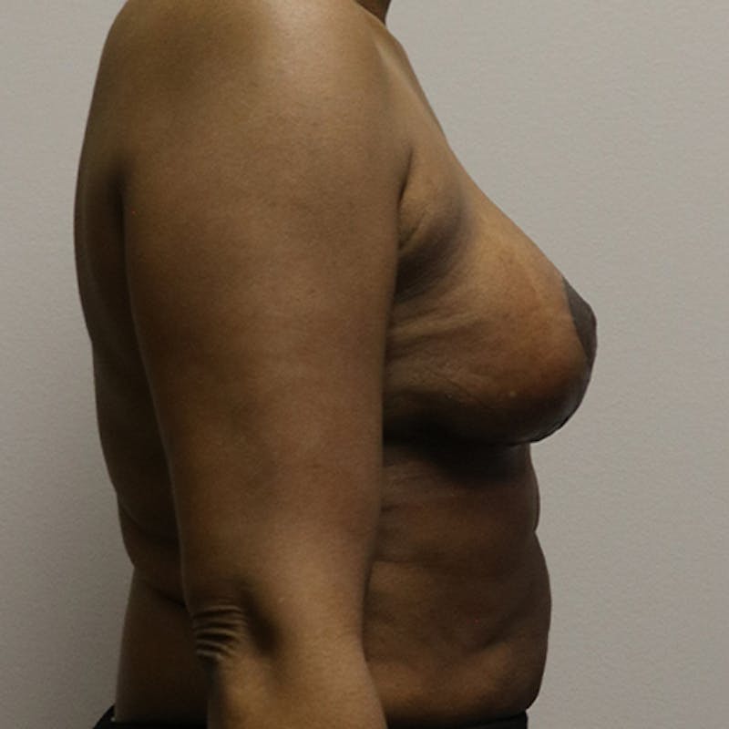 Breast Lift Before & After Gallery - Patient 843161 - Image 6