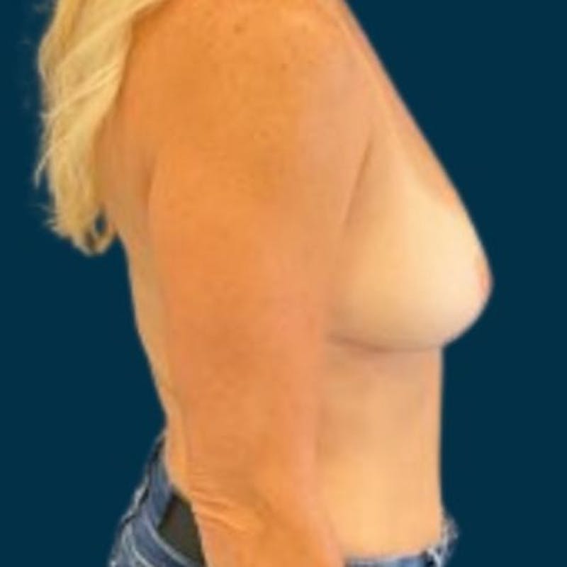 Breast Lift with Implants Before & After Gallery - Patient 352956 - Image 5