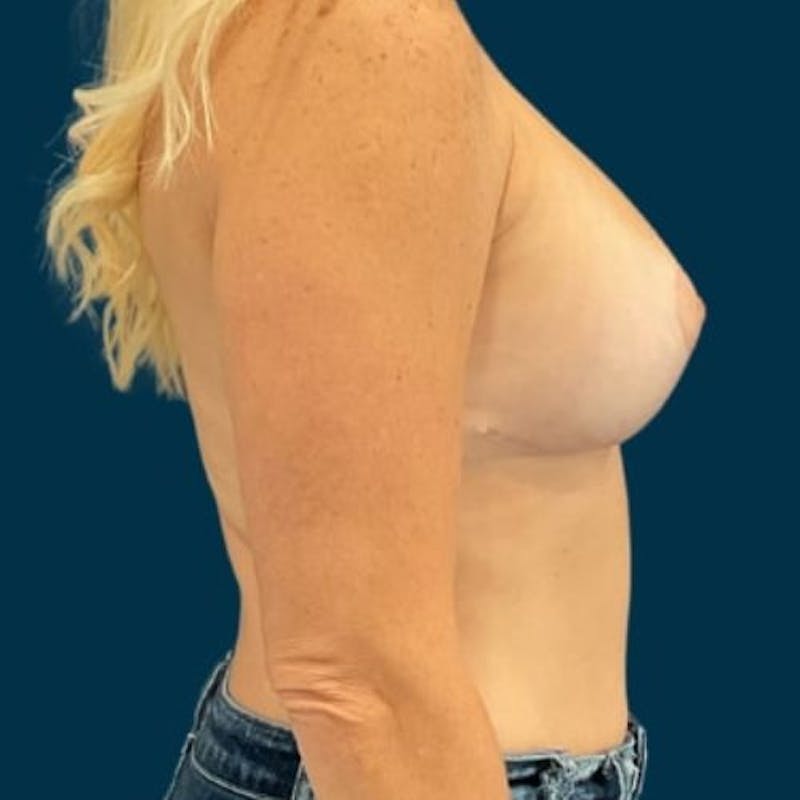 Breast Lift with Implants Before & After Gallery - Patient 352956 - Image 6