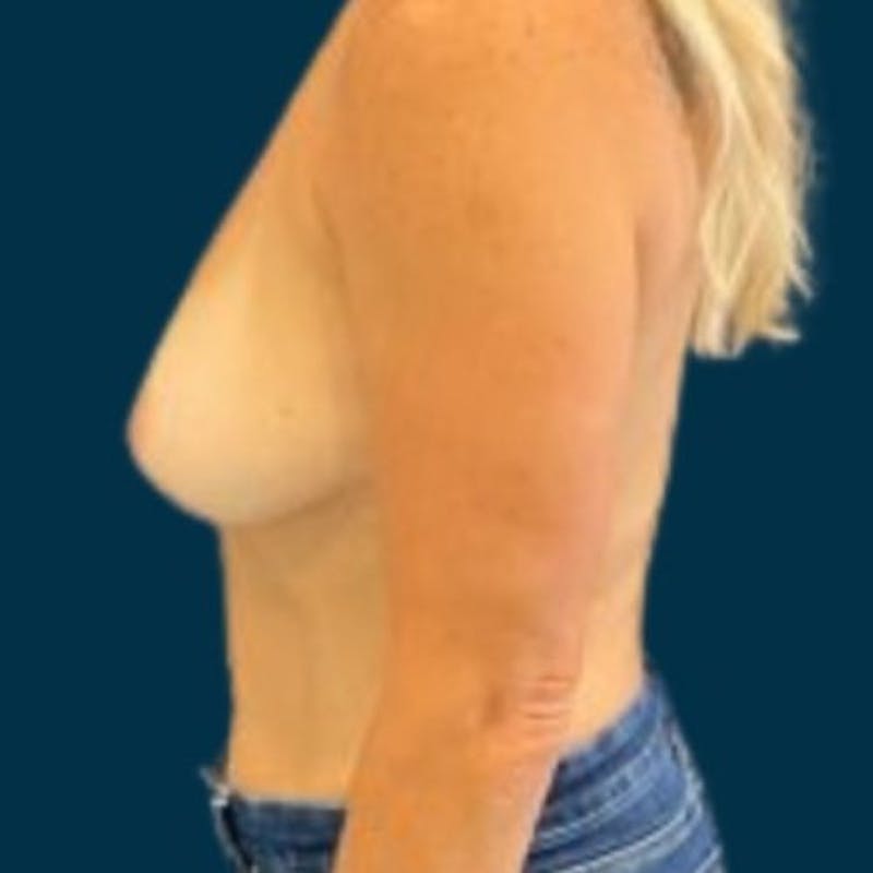 Breast Lift with Implants Before & After Gallery - Patient 352956 - Image 9