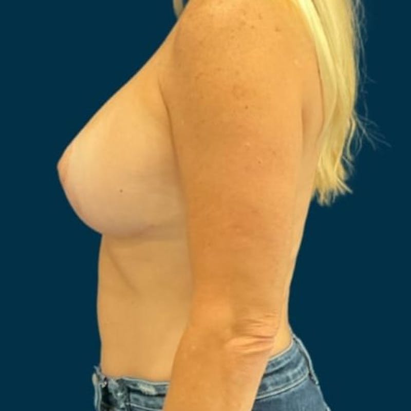 Breast Lift with Implants Before & After Gallery - Patient 352956 - Image 10