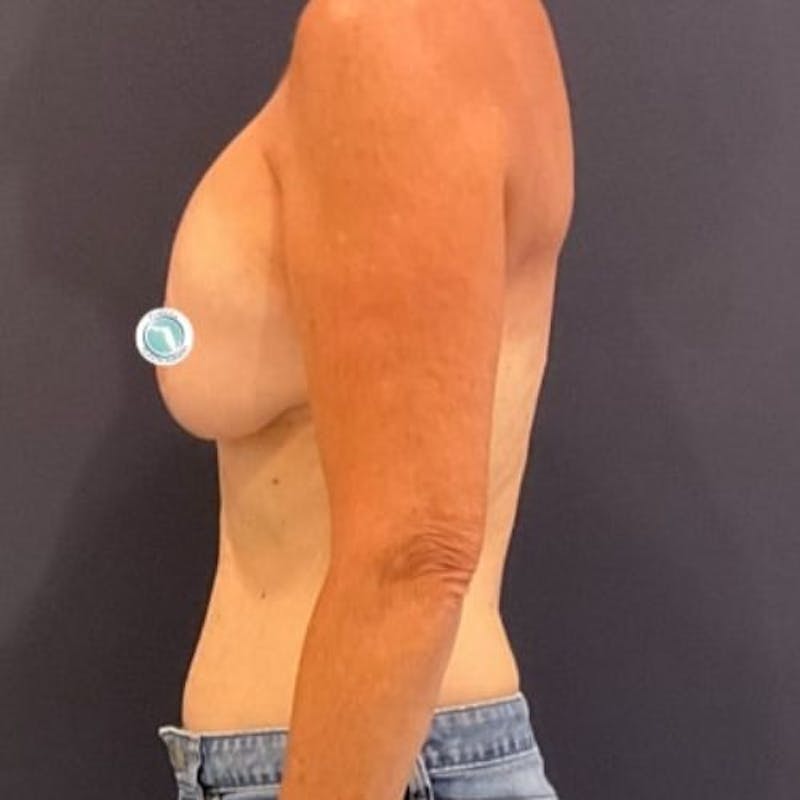 Breast Lift with Implants Before & After Gallery - Patient 225693 - Image 5