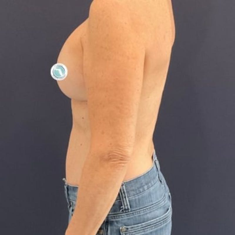 Breast Lift with Implants Before & After Gallery - Patient 225693 - Image 6