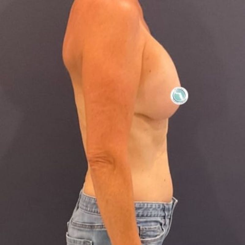 Breast Lift with Implants Before & After Gallery - Patient 225693 - Image 7