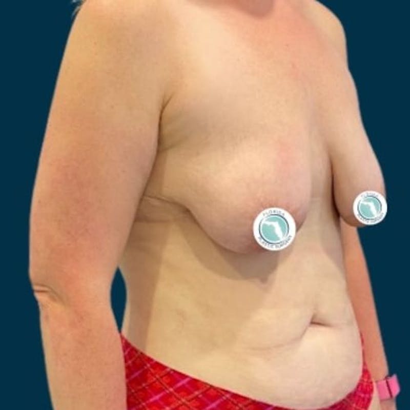 Breast Lift with Implants Before & After Gallery - Patient 181875 - Image 5