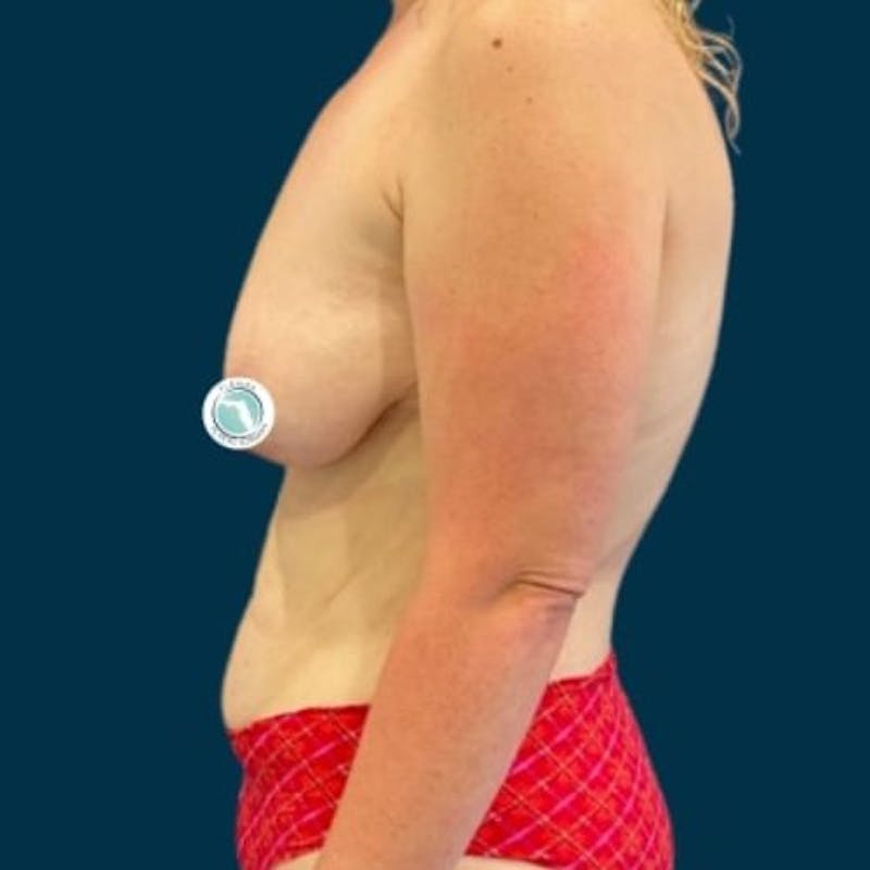 Breast Lift with Implants Before & After Gallery - Patient 181875 - Image 7