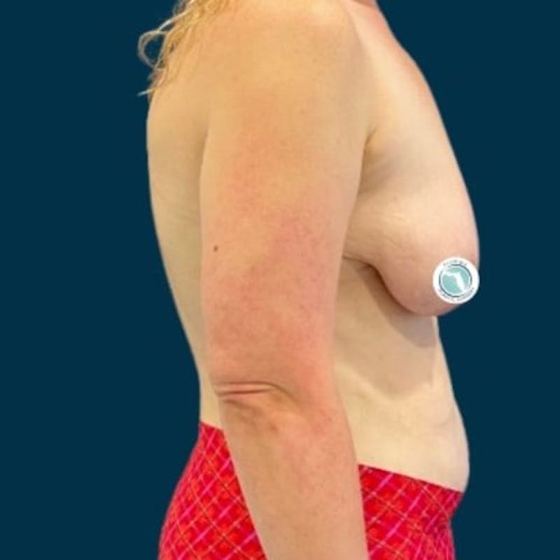 Breast Lift with Implants Before & After Gallery - Patient 181875 - Image 9