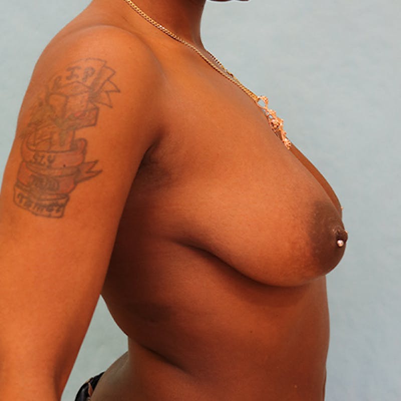 Breast Lift with Implants Before & After Gallery - Patient 194035 - Image 5