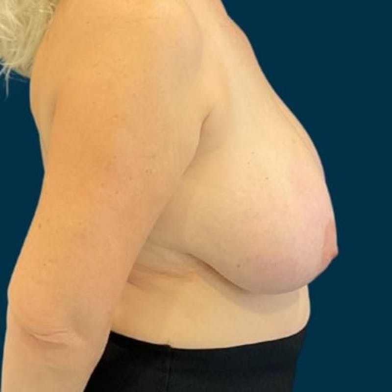 Breast Reduction Before & After Gallery - Patient 381994 - Image 3