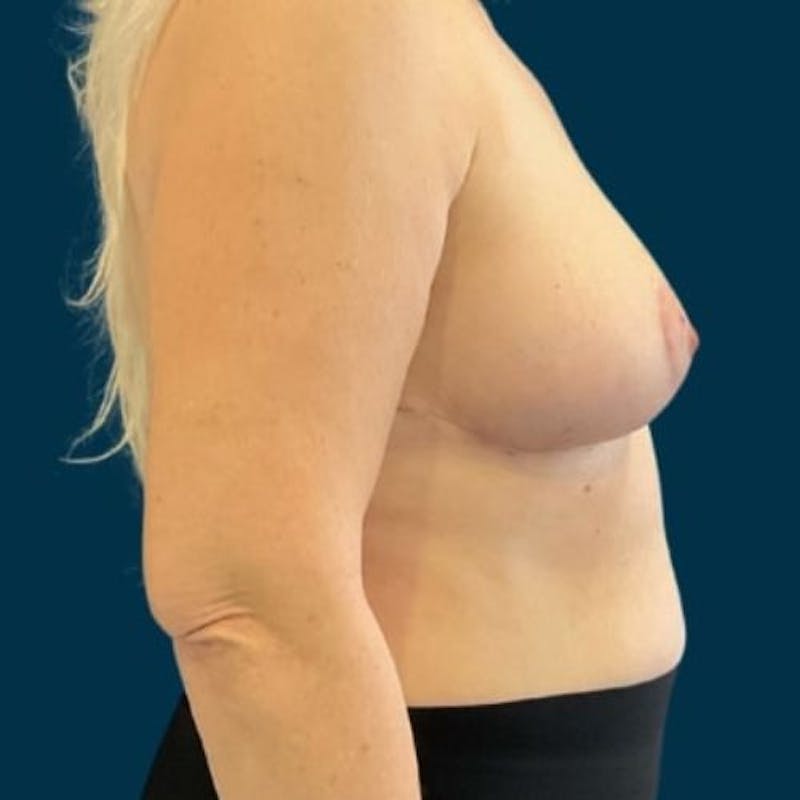 Breast Reduction Before & After Gallery - Patient 381994 - Image 4