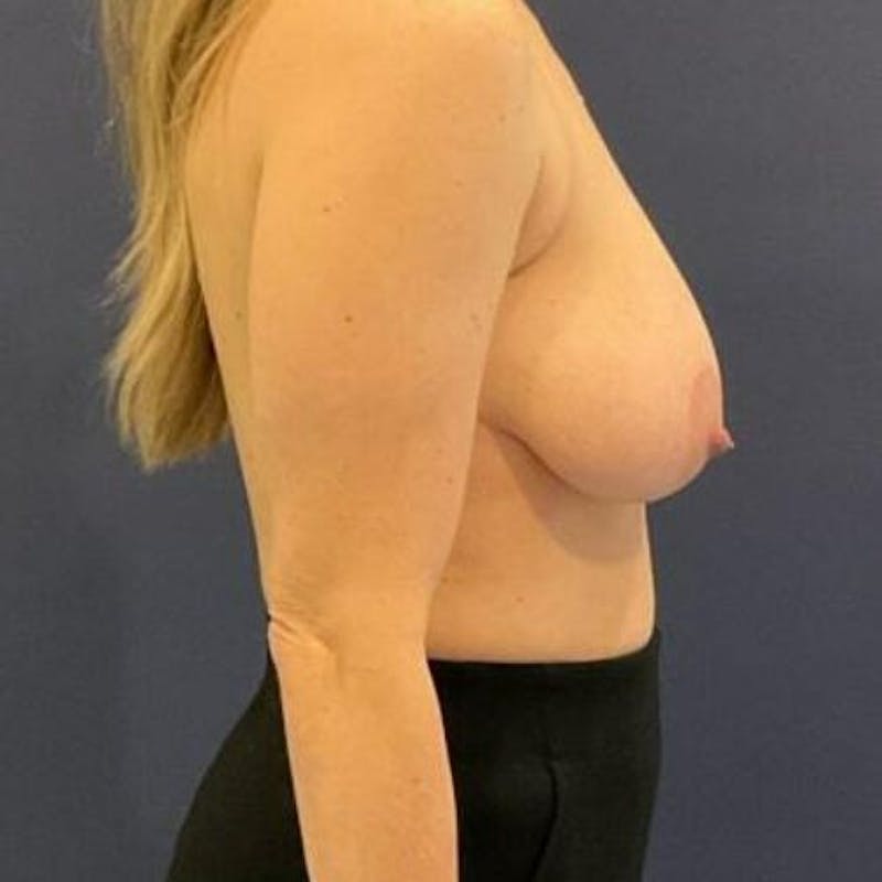 Breast Reduction Before & After Gallery - Patient 463728 - Image 3