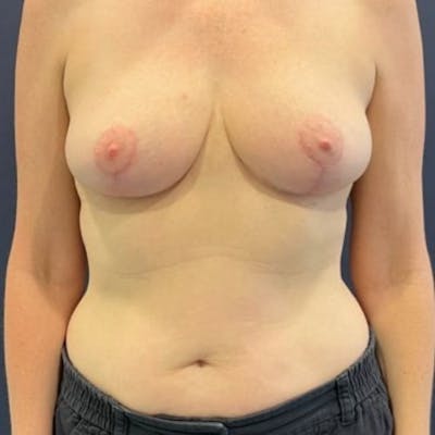 Breast Reduction Before & After Gallery - Patient 243482 - Image 2