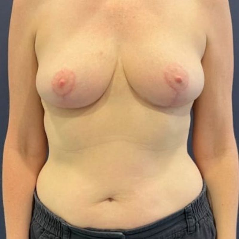 Breast Reduction Before & After Gallery - Patient 243482 - Image 2