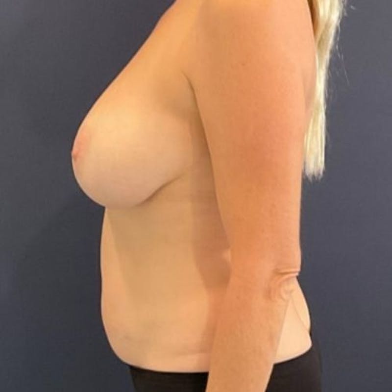 Breast Reduction Before & After Gallery - Patient 243482 - Image 5