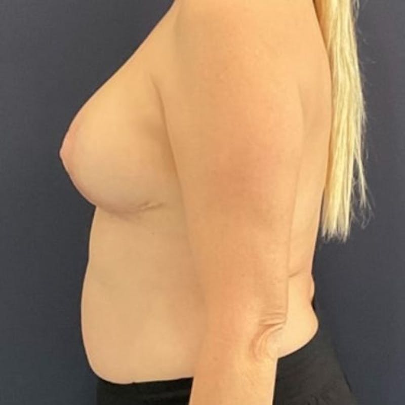 Breast Reduction Before & After Gallery - Patient 243482 - Image 6