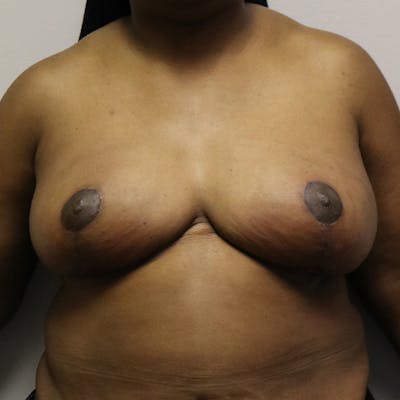 Breast Reduction Before & After Gallery - Patient 165515 - Image 2
