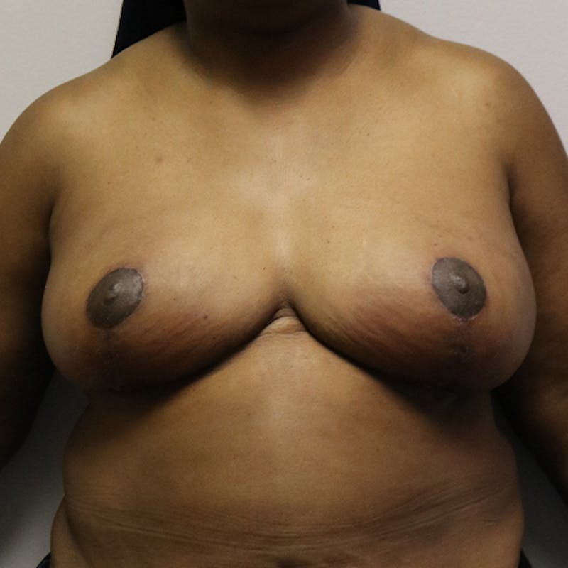 Breast Reduction Before & After Gallery - Patient 165515 - Image 2