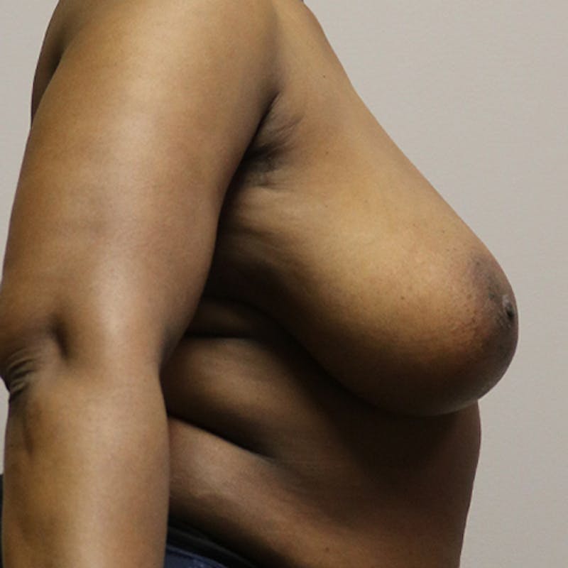 Breast Reduction Before & After Gallery - Patient 165515 - Image 5