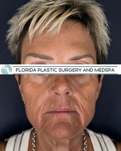CO2 Laser Before & After Gallery - Patient 276050 - Image 1