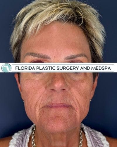 CO2 Laser Before & After Gallery - Patient 276050 - Image 2