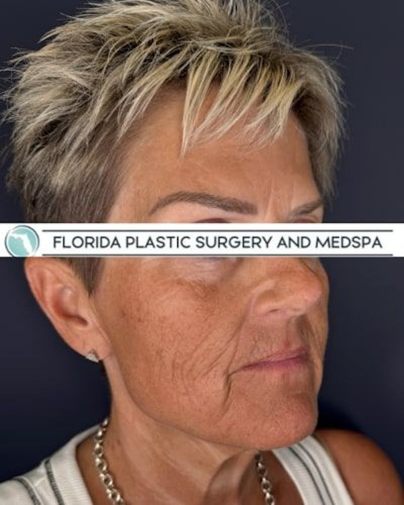 CO2 Laser Before & After Gallery - Patient 276050 - Image 3