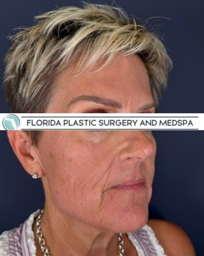 CO2 Laser Before & After Gallery - Patient 276050 - Image 4