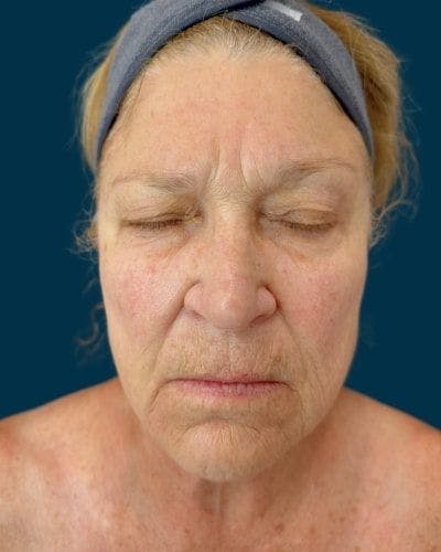 CO2 Laser Before & After Gallery - Patient 155845 - Image 1