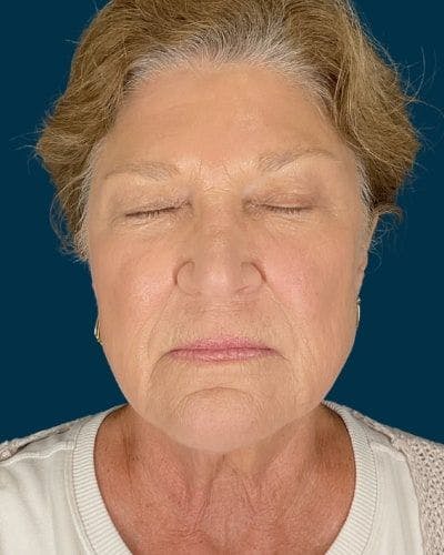 CO2 Laser Before & After Gallery - Patient 155845 - Image 2