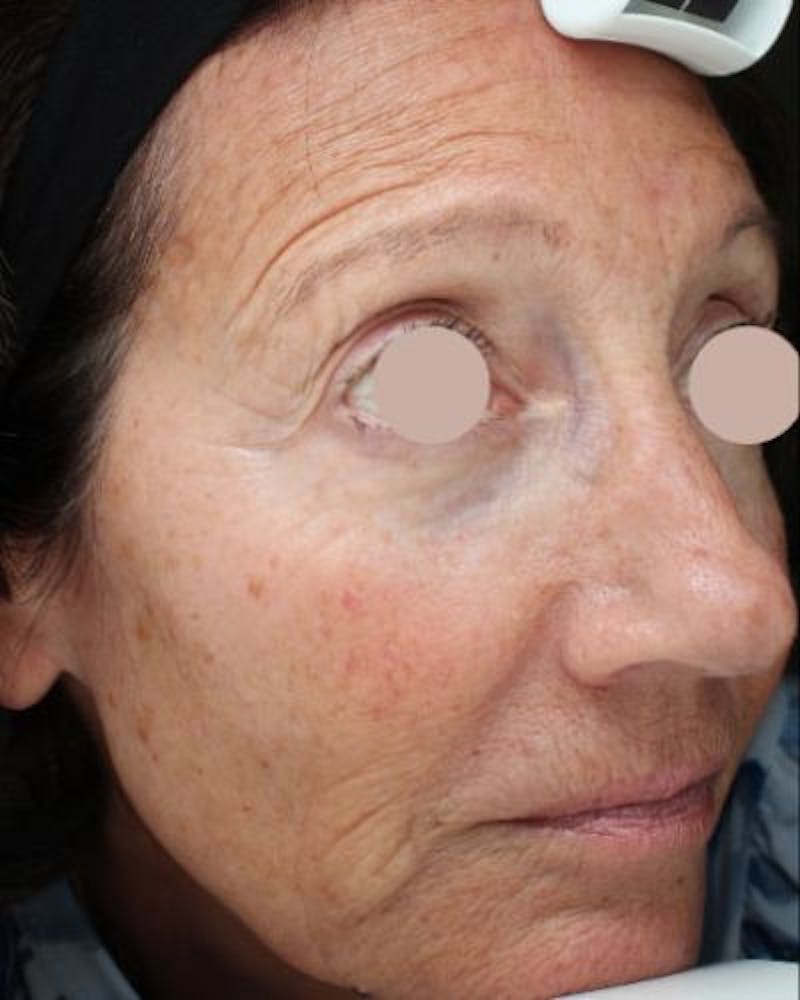 CO2 Laser Before & After Gallery - Patient 234440 - Image 1