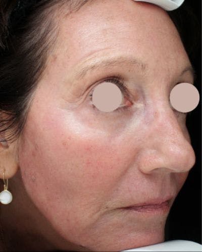 CO2 Laser Before & After Gallery - Patient 234440 - Image 2