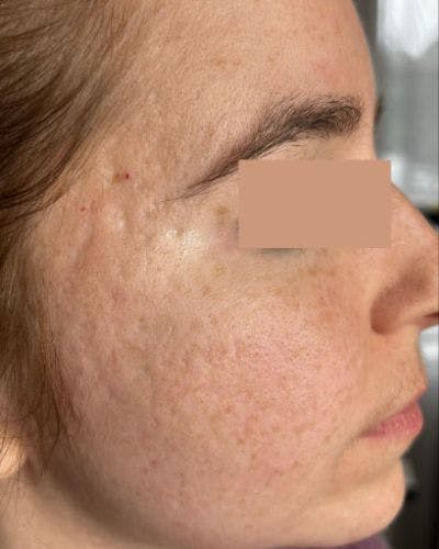 CO2 Laser Before & After Gallery - Patient 372986 - Image 1