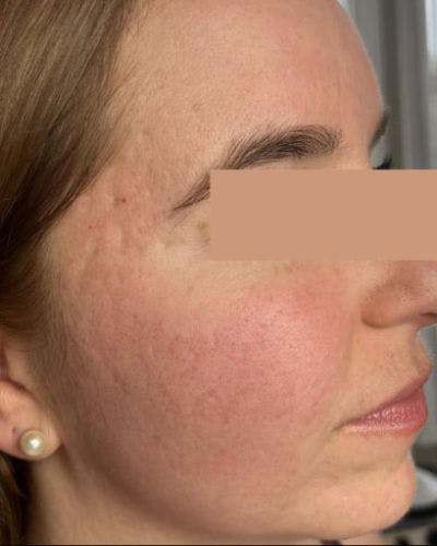 CO2 Laser Before & After Gallery - Patient 372986 - Image 2