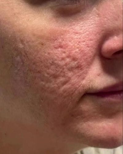 CO2 Laser Before & After Gallery - Patient 206921 - Image 1