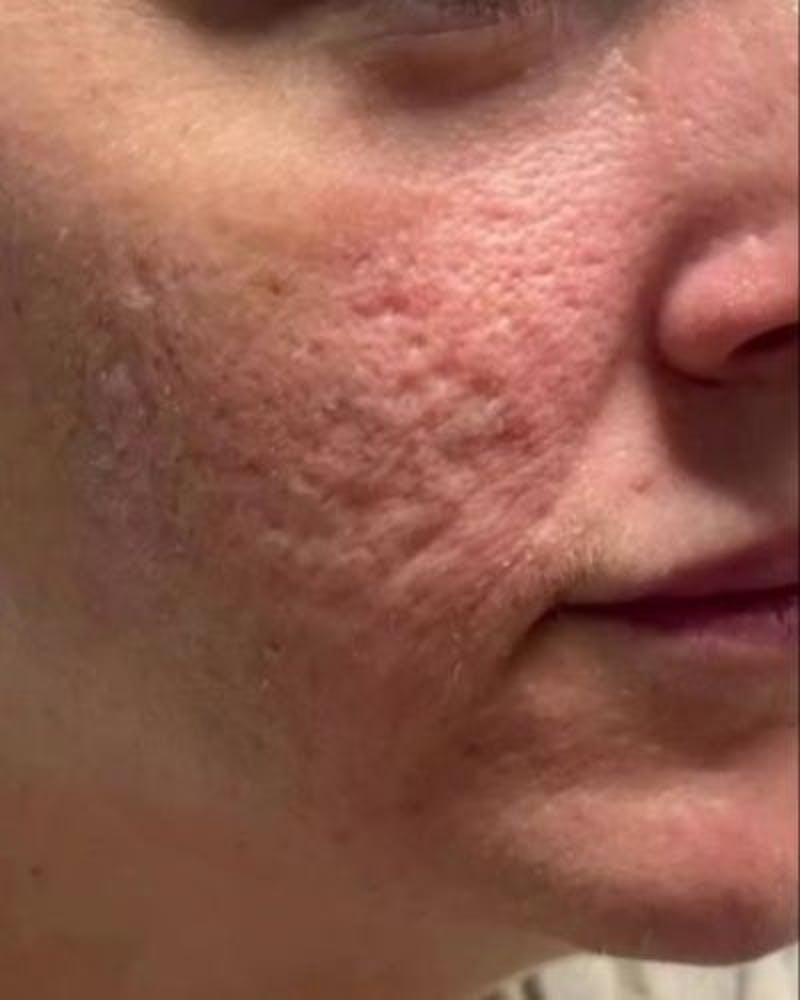 CO2 Laser Before & After Gallery - Patient 206921 - Image 1