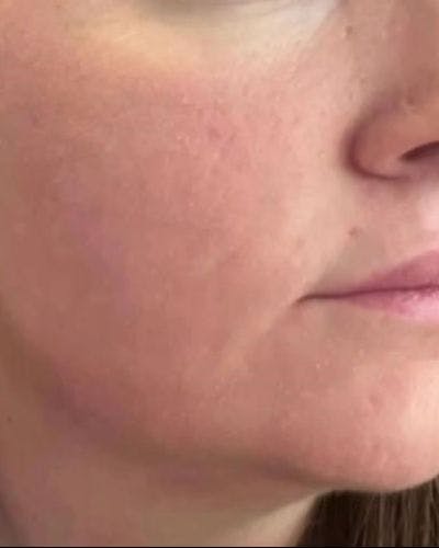 CO2 Laser Before & After Gallery - Patient 206921 - Image 2