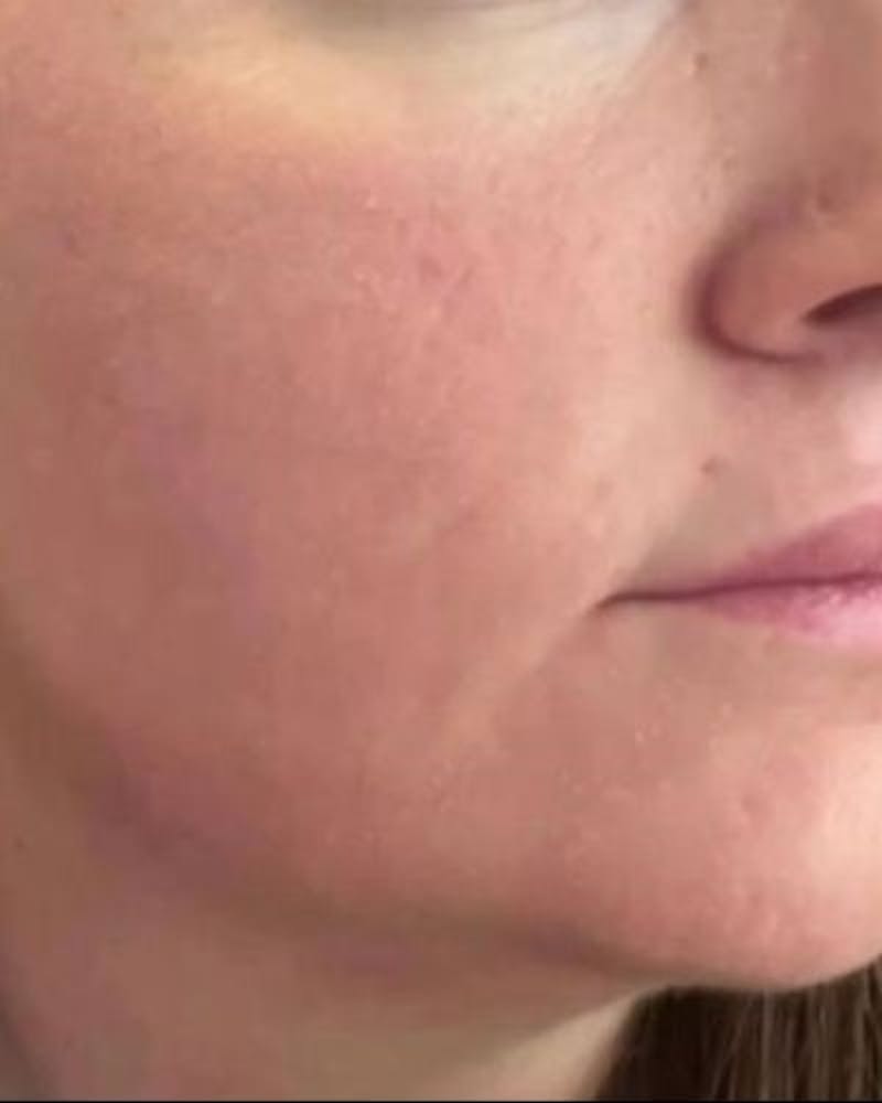 CO2 Laser Before & After Gallery - Patient 206921 - Image 2