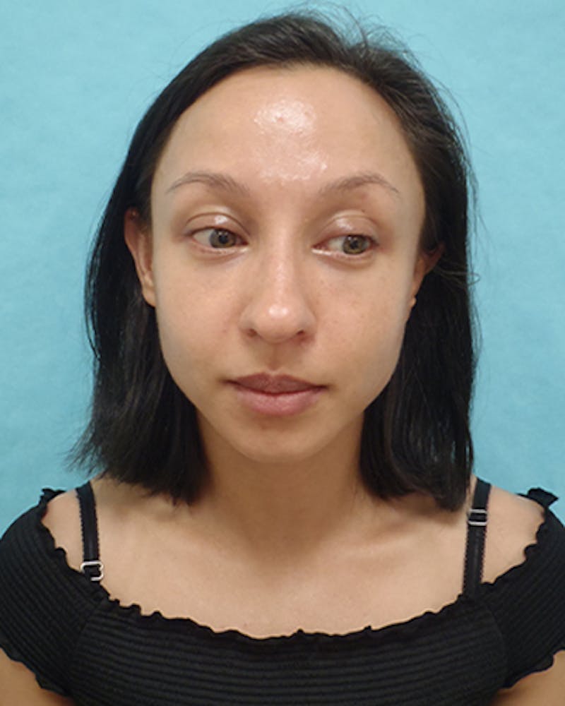 Chin Augmentation Before & After Gallery - Patient 242149 - Image 1