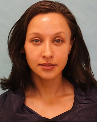 Chin Augmentation Before & After Gallery - Patient 242149 - Image 2