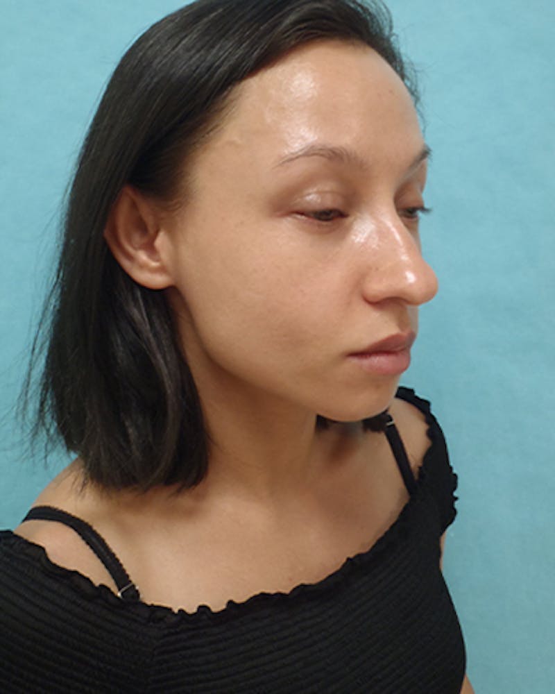 Chin Augmentation Before & After Gallery - Patient 242149 - Image 3