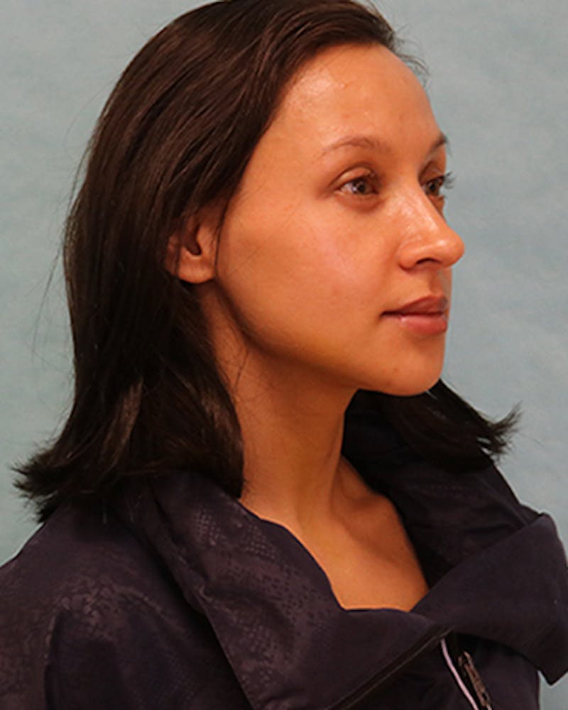 Chin Augmentation Before & After Gallery - Patient 242149 - Image 4