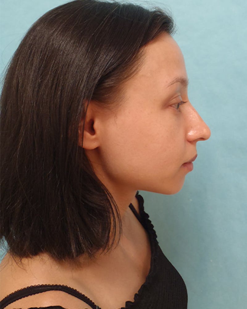 Chin Augmentation Before & After Gallery - Patient 242149 - Image 5