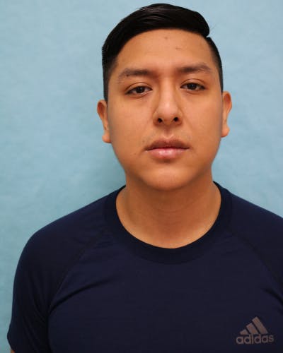 Chin Augmentation Before & After Gallery - Patient 799042 - Image 2