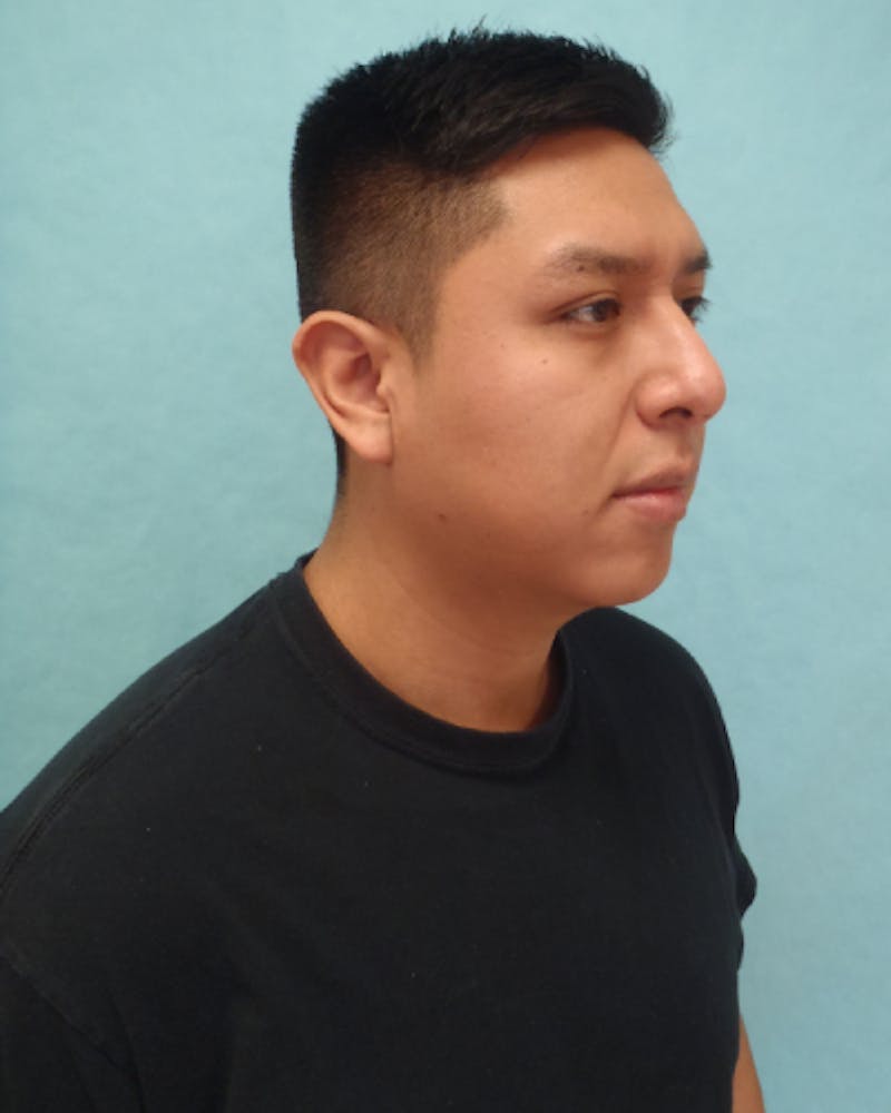 Chin Augmentation Before & After Gallery - Patient 799042 - Image 3