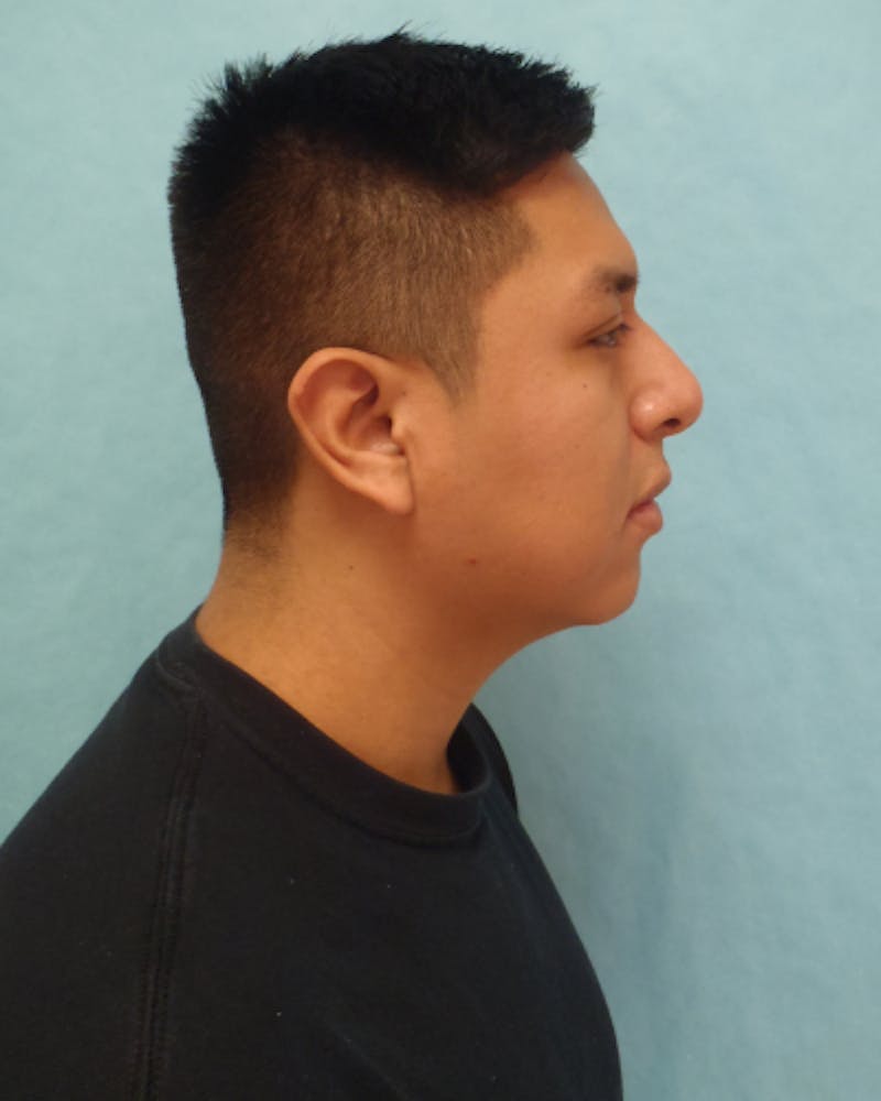 Chin Augmentation Before & After Gallery - Patient 799042 - Image 5