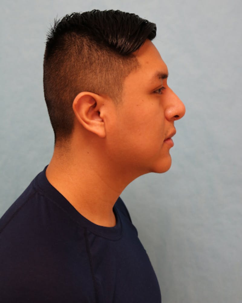 Chin Augmentation Before & After Gallery - Patient 799042 - Image 6