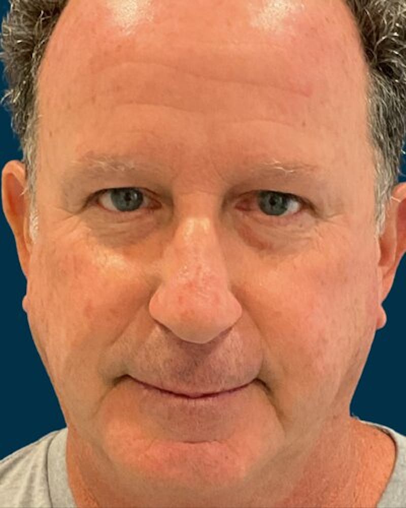 Eyelid Lift Before & After Gallery - Patient 366153 - Image 1