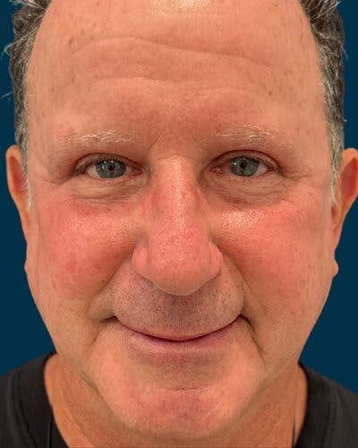 Eyelid Lift Before & After Gallery - Patient 366153 - Image 2