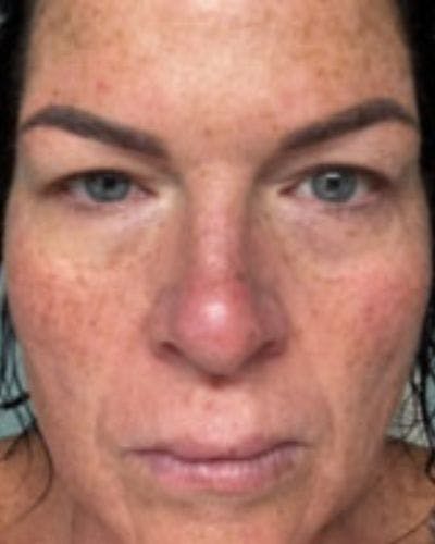 Eyelid Lift Before & After Gallery - Patient 120387 - Image 1