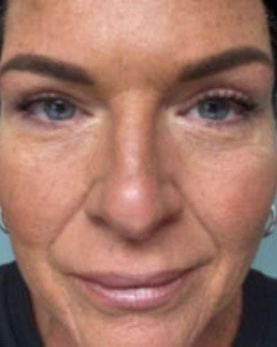 Eyelid Lift Before & After Gallery - Patient 120387 - Image 2